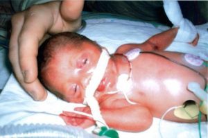 Preemie baby